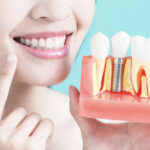 Things to Know before Dental Implants