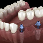 What Is the Material of Dental Implant