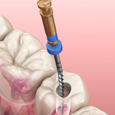 What to Understand before Trying Root Canal Therapy