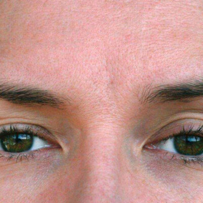 Exercises To Strengthen Drooping Eyelid Muscles