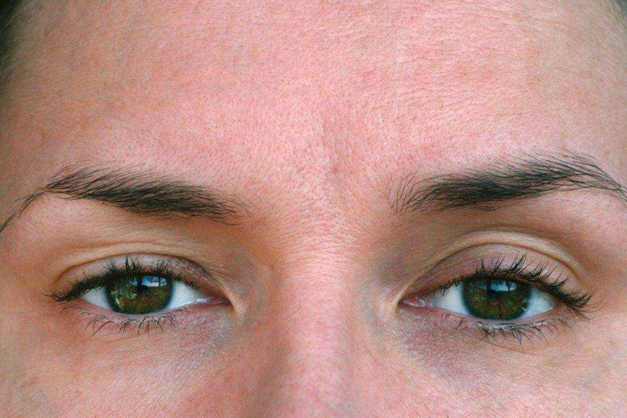 Exercises To Strengthen Drooping Eyelid Muscles