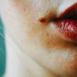 Exploring The Efficacy Of Lip Reduction Technique For Facial Harmony 