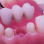 Smile Restoration Unraveling the Cost of Fixed Bridge in Manila Philippines