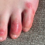 Common Symptoms of Chilblains You Should Never Ignore in Cold Weather