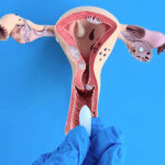 Pelvic Organ Prolapse Houston Advanced Surgical Vs Conservative Treatment Options
