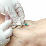 Are You a Candidate for Varicose Vein Surgery in Singapore