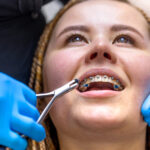 Cheap Braces in Singapore What to Expect and Where to Look