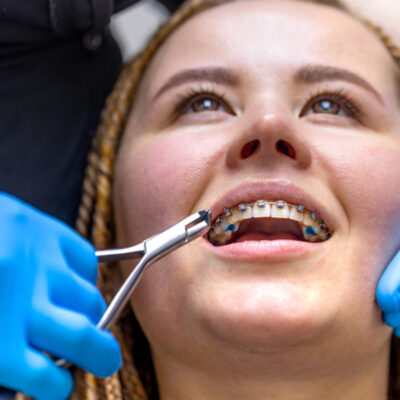 Cheap Braces in Singapore What to Expect and Where to Look