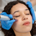 Choosing Your Laser Treatment for Acne Scars A Guide to Your Options