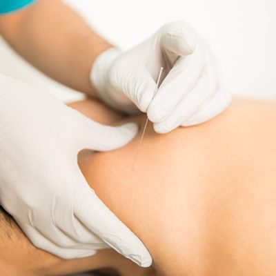 4 Key Differences Between TCM Acupuncture and Western Therapies in Singapore