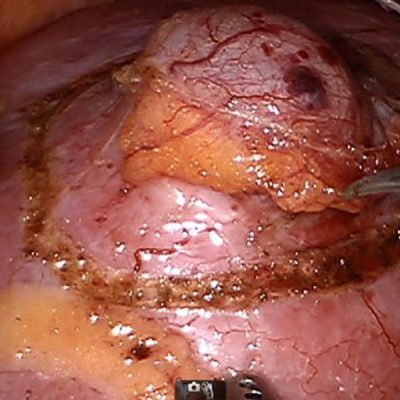 Gain the Most Out of Robotic Surgery Fellowship Training